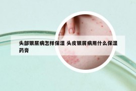 头部银屑病怎样保湿 头皮银屑病用什么保湿药膏