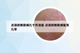 点滴状银屑病几个月消退 点滴状银屑病复发几率