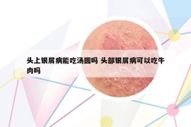 头上银屑病能吃汤圆吗 头部银屑病可以吃牛肉吗