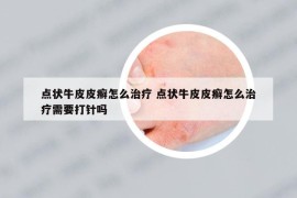 点状牛皮皮癣怎么治疗 点状牛皮皮癣怎么治疗需要打针吗