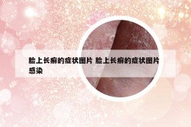 脸上长癣的症状图片 脸上长癣的症状图片 感染