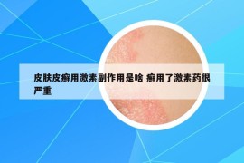 皮肤皮癣用激素副作用是啥 癣用了激素药很严重