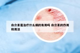 白介素是治疗什么病的有用吗 白介素的作用和用法