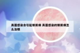 真菌感染会引起银屑病 真菌感染的银屑病怎么治根