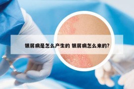 银屑病是怎么产生的 银屑病怎么来的?