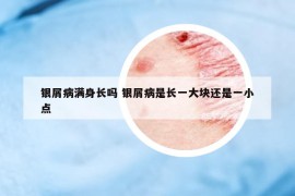 银屑病满身长吗 银屑病是长一大块还是一小点