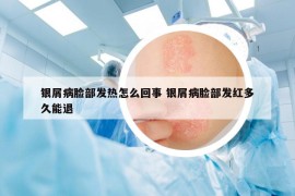 银屑病脸部发热怎么回事 银屑病脸部发红多久能退