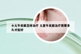 小儿牛皮廨怎样治疗 儿童牛皮廨治疗需要多久才能好