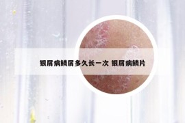 银屑病鳞屑多久长一次 银屑病鳞片