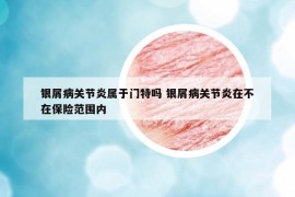 银屑病关节炎属于门特吗 银屑病关节炎在不在保险范围内