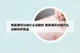 银屑病可以抹什么润肤的 银屑病可以抹什么润肤的护肤品