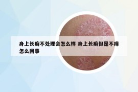 身上长癣不处理会怎么样 身上长癣但是不痒怎么回事