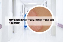 潍坊银屑病医院治疗方法 潍坊治疗银屑病哪个医院最好