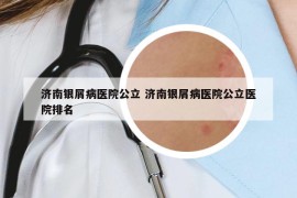 济南银屑病医院公立 济南银屑病医院公立医院排名