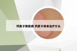 钙离子银屑病 钙离子用来治疗什么