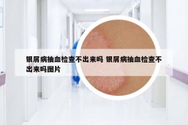 银屑病抽血检查不出来吗 银屑病抽血检查不出来吗图片