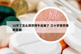 32岁了怎么突然得牛皮癣了 三十岁突然得银屑病