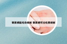 银屑病能吃白胡椒 银屑病可以吃黑胡椒