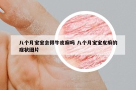 八个月宝宝会得牛皮癣吗 八个月宝宝皮癣的症状图片