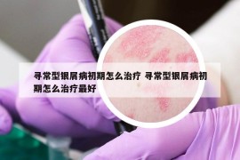 寻常型银屑病初期怎么治疗 寻常型银屑病初期怎么治疗最好