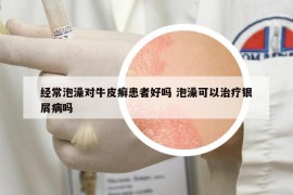 经常泡澡对牛皮癣患者好吗 泡澡可以治疗银屑病吗