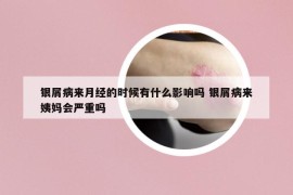 银屑病来月经的时候有什么影响吗 银屑病来姨妈会严重吗