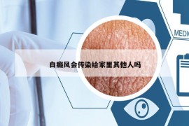 白癜风会传染给家里其他人吗