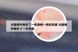 大腿根外侧长了一些像癣一样的东西 大腿根外侧长了一片疙瘩