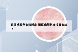 银屑病颜色变淡脱皮 银屑病颜色变浅又变红了