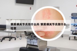 银屑病关节炎挂什么科 银屑病关节炎做什么检查