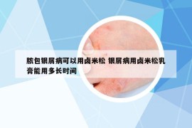 脓包银屑病可以用卤米松 银屑病用卤米松乳膏能用多长时间