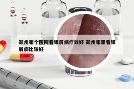 郑州哪个医院看银屑病疗效好 郑州哪里看银屑病比较好