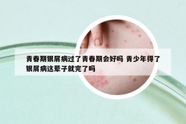 青春期银屑病过了青春期会好吗 青少年得了银屑病这辈子就完了吗