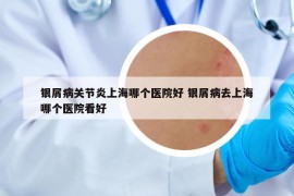 银屑病关节炎上海哪个医院好 银屑病去上海哪个医院看好