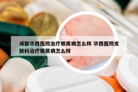 成都华西医院治疗银屑病怎么样 华西医院皮肤科治疗银屑病怎么样