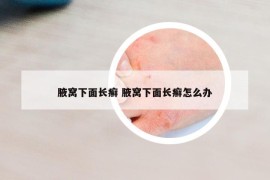 腋窝下面长癣 腋窝下面长癣怎么办