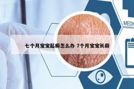 七个月宝宝起癣怎么办 7个月宝宝长藓