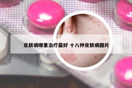 皮肤病哪里治疗最好 十八种皮肤病图片