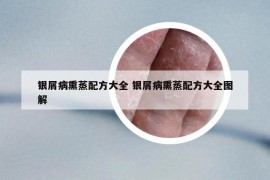 银屑病熏蒸配方大全 银屑病熏蒸配方大全图解