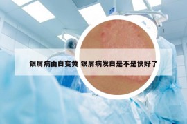 银屑病由白变黄 银屑病发白是不是快好了