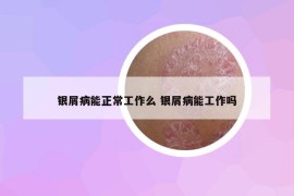 银屑病能正常工作么 银屑病能工作吗