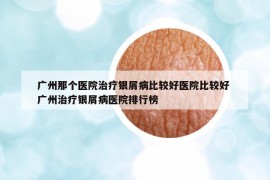 广州那个医院治疗银屑病比较好医院比较好 广州治疗银屑病医院排行榜