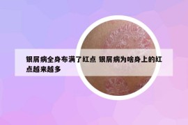 银屑病全身布满了红点 银屑病为啥身上的红点越来越多