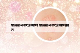 银屑病可以吃辣根吗 银屑病可以吃辣根吗图片