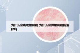 为什么会出现银屑病 为什么会得银屑病能治好吗