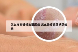 怎么样能够根治银屑病 怎么治疗银屑病见效快