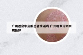 广州适合牛皮癣患者生活吗 广州哪家治银屑病最好