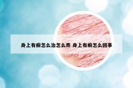 身上有癣怎么治怎么弄 身上有癣怎么回事