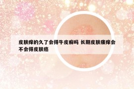 皮肤痒的久了会得牛皮癣吗 长期皮肤瘙痒会不会得皮肤癌