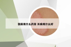 张藓用什么药膏 长癣用什么好